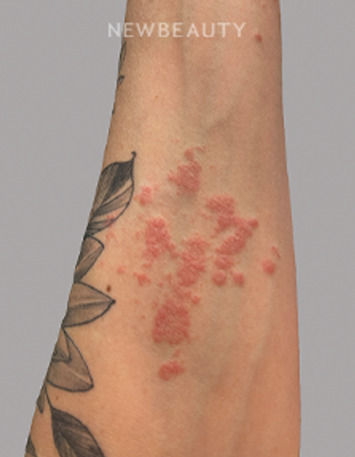 Dr. Anna Chacon - Psoriasis - 34279380 - Before