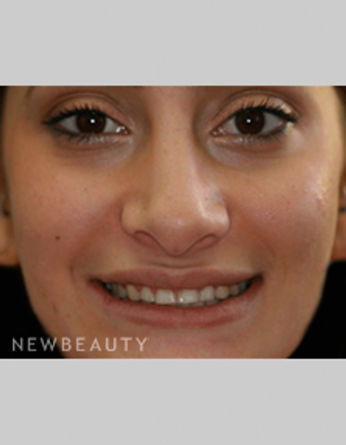 Dr. Bob Perkins Veneers - Before