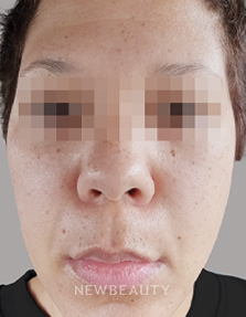 Dr. Anna Chacon - Angular Cheilitis - 34279225 - After