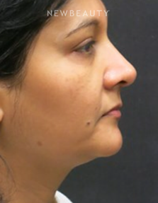 Dr. Jody Levine - Facial Rejuvenation - Before