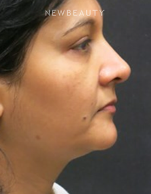 Dr. Jody Levine - Facial Rejuvenation - Before