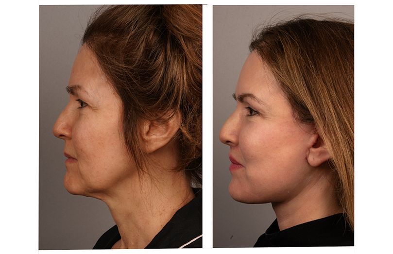 Her side profile shows lifted jowls, a defined jawline and smoother skin.