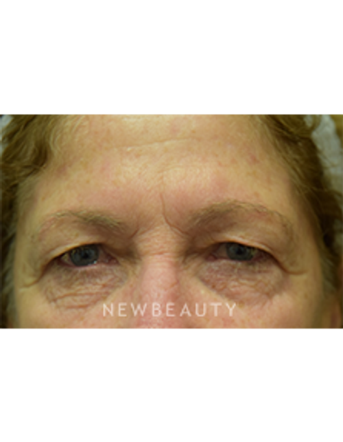 Dr. Jeffrey B. Wise - Eyelift - Before