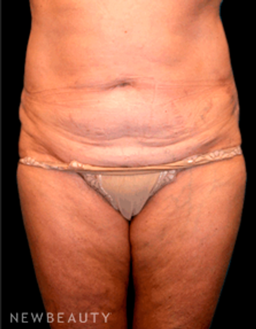 Dr. Christine Hamori Tummy Tuck - Before