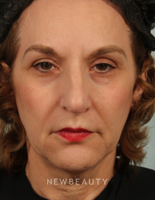 Dr. Kenneth R. Beer - Natural-Looking Fullness - After