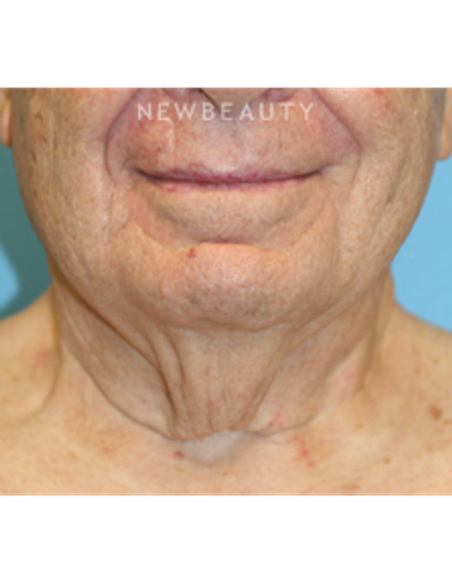 Dr. Christine Hamori - Necklift - Before