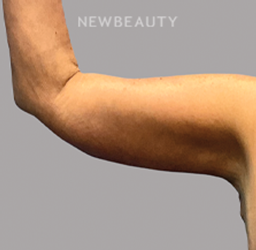 DR.PHILIPPE A.CAPRARO - Arm Lift - 46190990 - After
