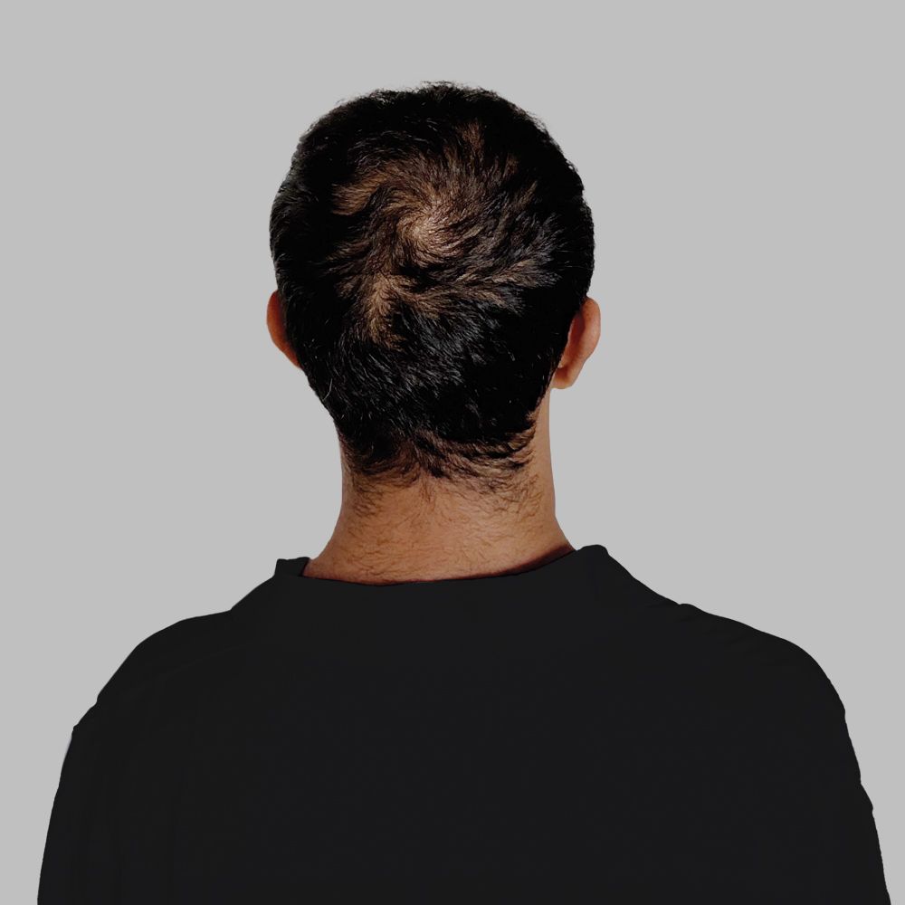 After Follicular Unit Extraction (FUE) hair transplant