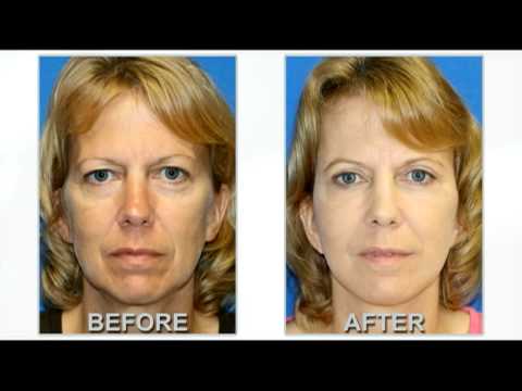 Dr. Karam Fat Transfer to Face, Facelift Surgery & Upper Eyelid Surgery Before and After