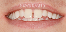 Dr. Nathan Hoffman - Invisalign & Teeth Whitening - Before