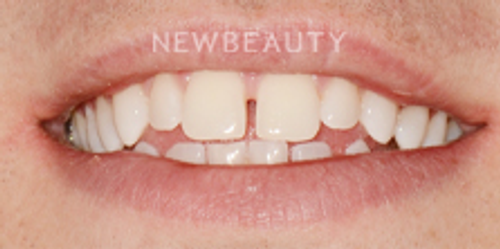 Dr. Nathan Hoffman - Invisalign & Teeth Whitening - Before