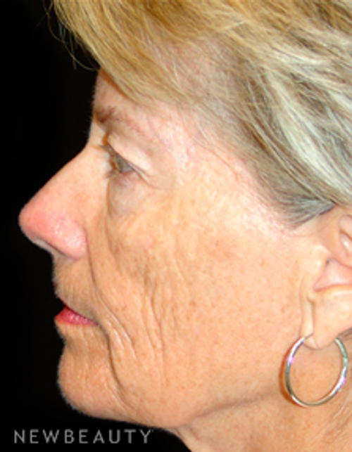 Dr. Mokhtar Asaadi Eyelid, Lift Facelift - Before