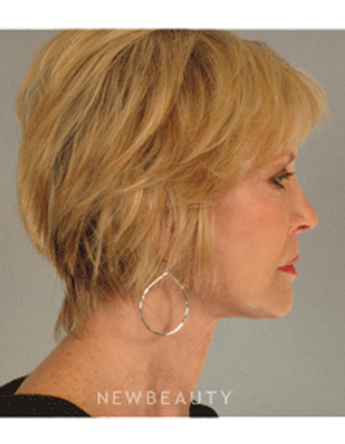 Dr. Mentz - Eyelift, Facelift, Necklift - After