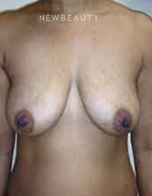 Dr. B. Aviva Preminger - Breast Lift - Before