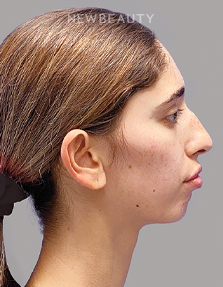 Dr. Paul Afrooz - Beautifully Balanced Results - - Before