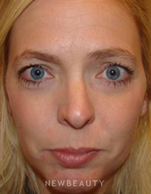 Dr. Joel Schlessinger - Dysport - Before