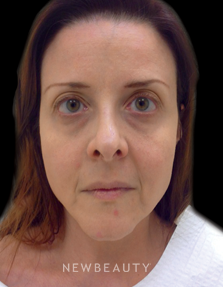 Dr. Julie Russak - Injectables & Fillers - Before