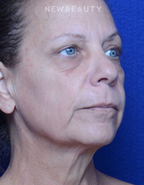 Dr. Alan Durkin - Facelift - Before