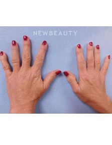 Dr. Kenneth Beer- Injectables and Fillers - After