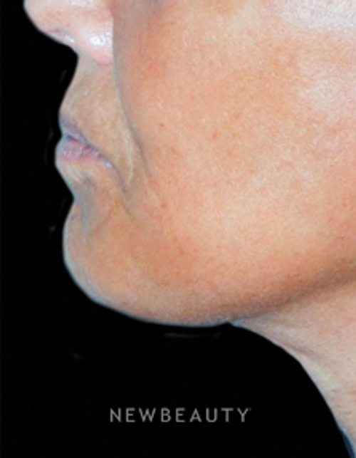 Dr. Roman Rayham - Restoring Youthfulness - After