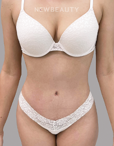 Dr. Daniel Crane - Tummy Transformation - 44688571 - After