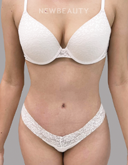 Dr. Daniel Crane - Tummy Transformation - 44688571 - After