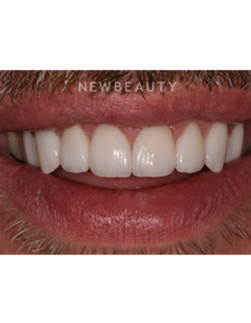 Dr. Sara Cummins - Smile Makeover - After