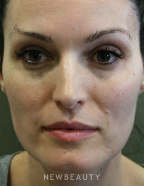 Dr. John Kang - Restoring Volume With Fat Transfer - Before