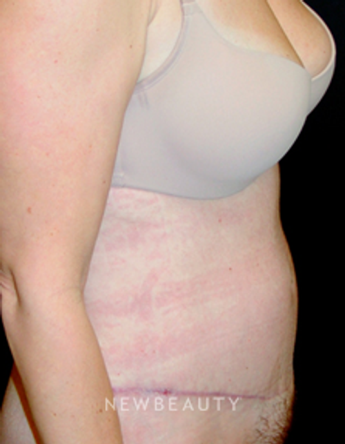 Dr. Mokhtar Asaadi Liposuction, Tummy Tuck - After