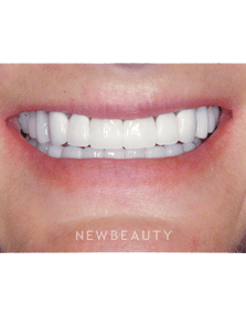 Dr. Guy M. Lewis - Smile Makeover - After