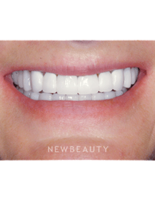 Dr. Guy M. Lewis - Smile Makeover - After