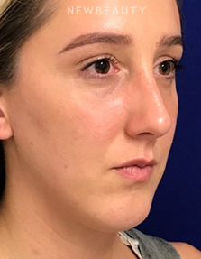 Dr. Dilip Madnani - Lower Blepharoplasty - After