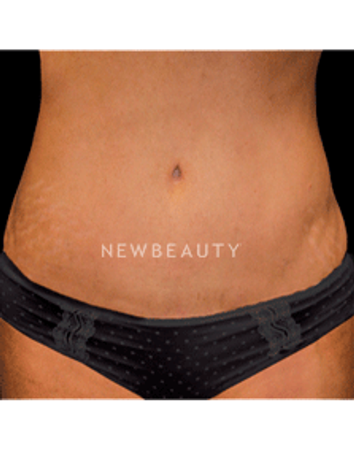 Dr. Christine Hamori Laser Liposuction, Skin Tightening - After