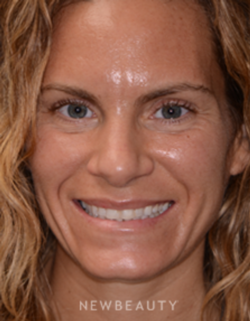 Dr. Irene Grafman - Smile Makeover - Before