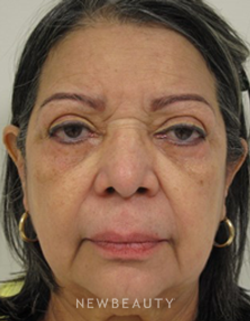 Dr. Aviva Preminger - Facelift - Before