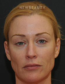 Dr. Janet Allenby - Injectables & Fillers - Before