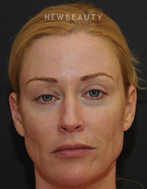 Dr. Janet Allenby - Injectables & Fillers - Before