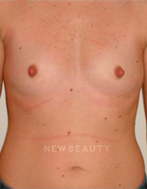 Dr. Michael Horn Silicone Breast Implants - Before