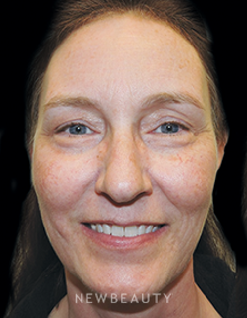 Dr. Joel Schlessinger - Youthful Rejuvenation - Before