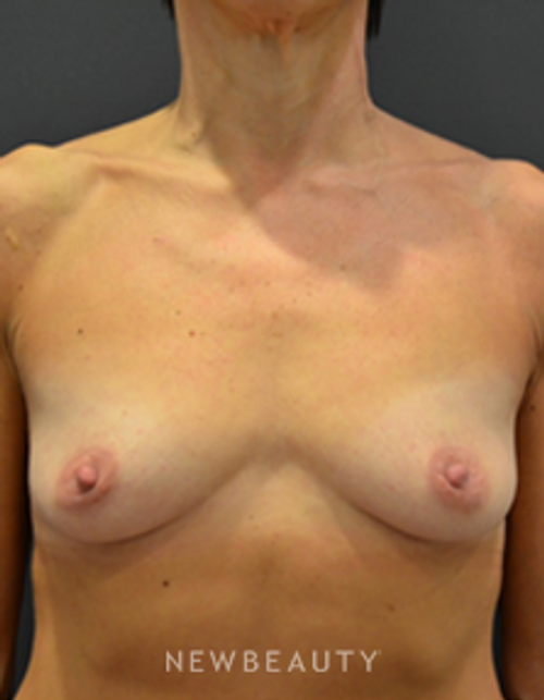 Dr. Aviva Preminger - Breast Augmentation - Before