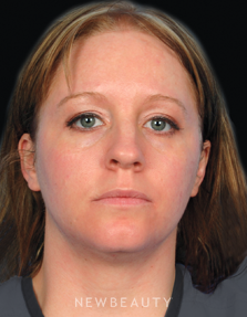 Dr. Kelly Bomer Injectables & Fillers - Before