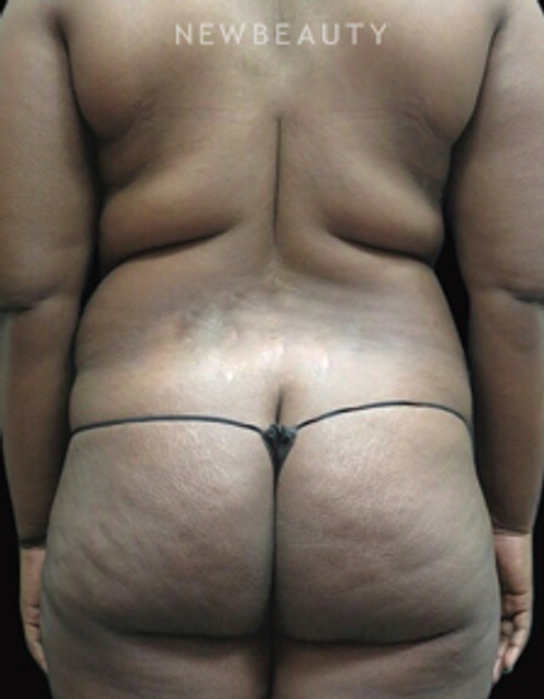 Dr. Elie Levine - Liposuction - Before