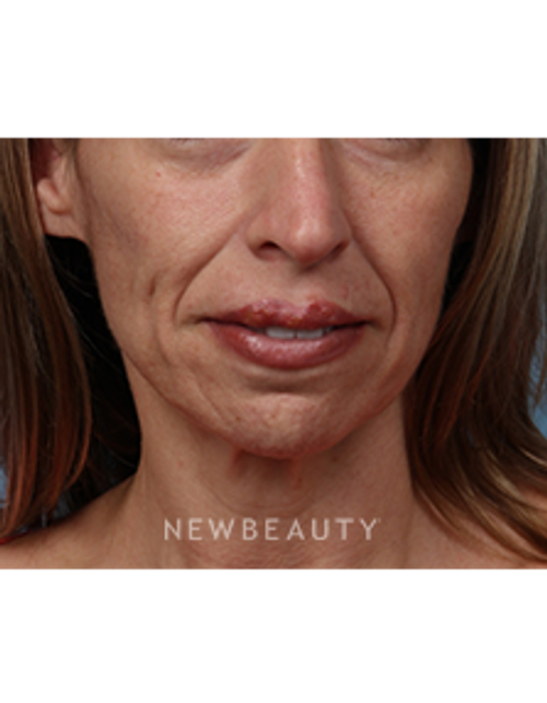 Dr. Kathleen Behr - Injectables - Before