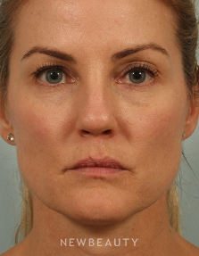 Dr. Kenneth Beer - Natural-Looking Rejuvenation - After