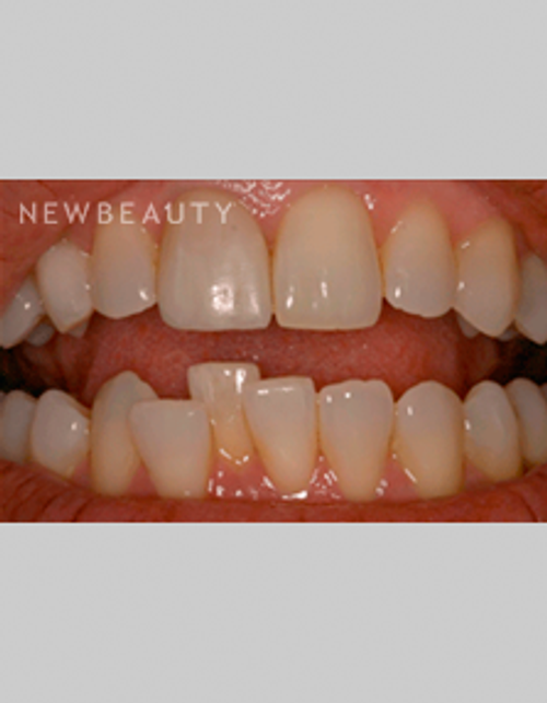 Dr. Bob Perkins Veneers, Invisalign - Before