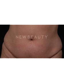 Dr. Ruth Hillelson Coolsculpting by Zeltiq - Before