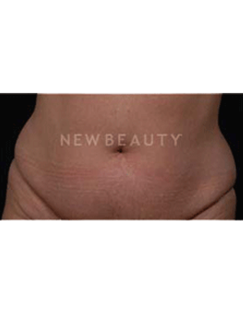 Dr. Ruth Hillelson Coolsculpting by Zeltiq - Before