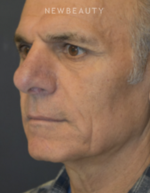 Drs. Lieberman & Parikh - Signature Facelift - Before