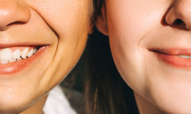dermelect upper lip lines treatment