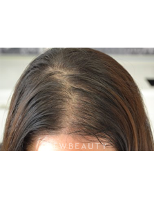 Dr. Julie Russak - Hair Loss Treatment - Before